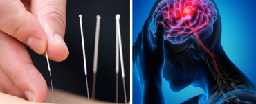 acupunctura-avc