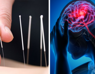 acupunctura-avc