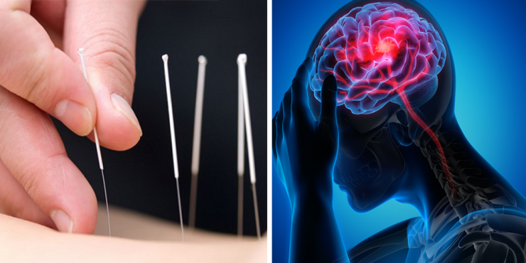 acupunctura-avc